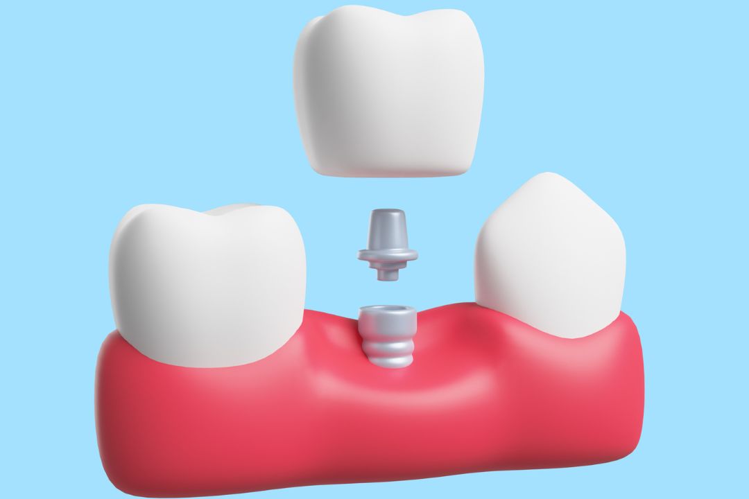 dental implants 